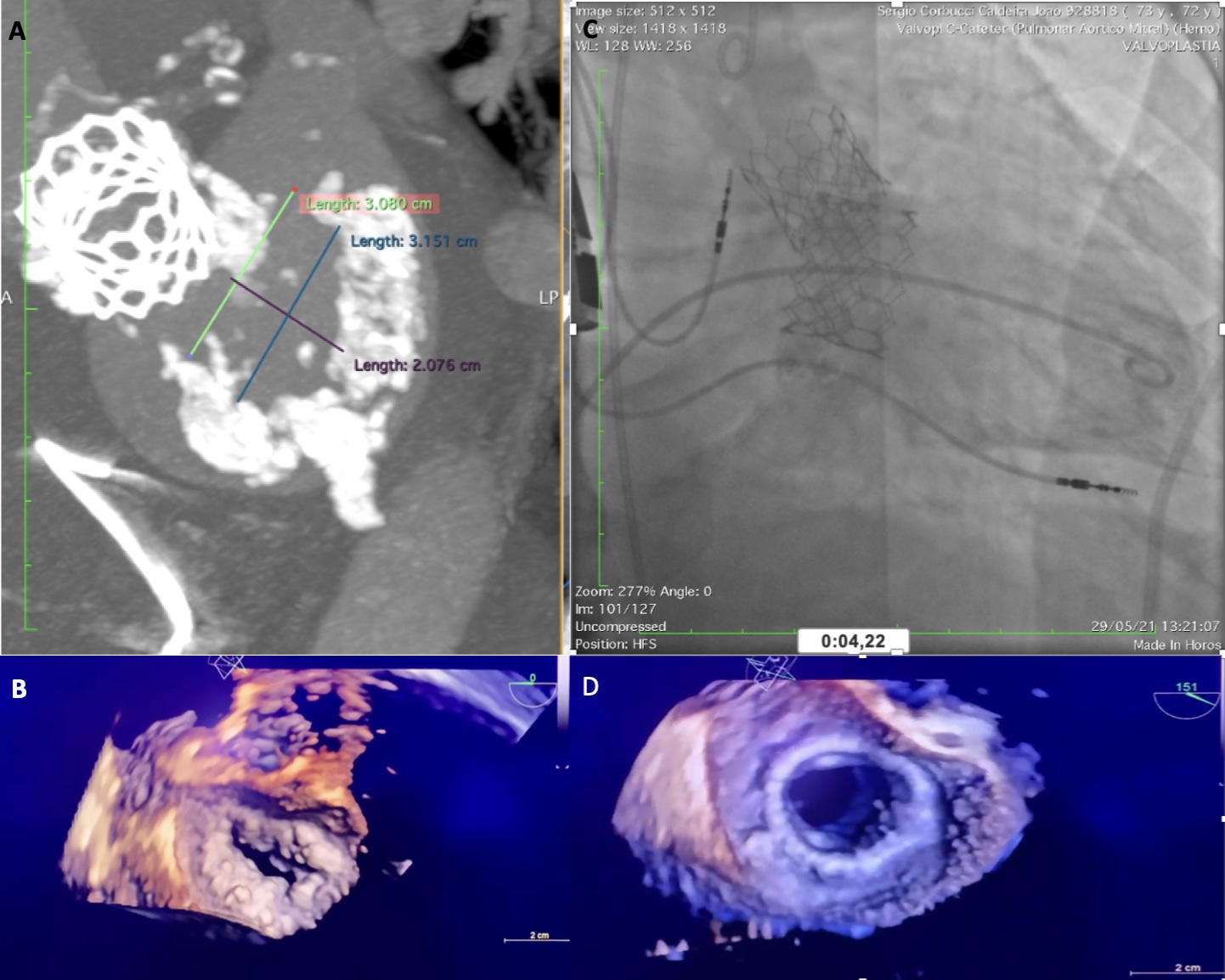 Figura: A. Calcificação do anel valvar na angioTC; B. Valvopatia no Eco3D; C. Disposição das próteses aórtica e mitral pós ViMAC; D. Eco 3D pós ViMac.